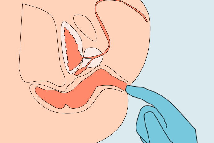 (1)直肠指检:医师将食指伸入受检者肛门并触摸肠壁检查是否存在疑似